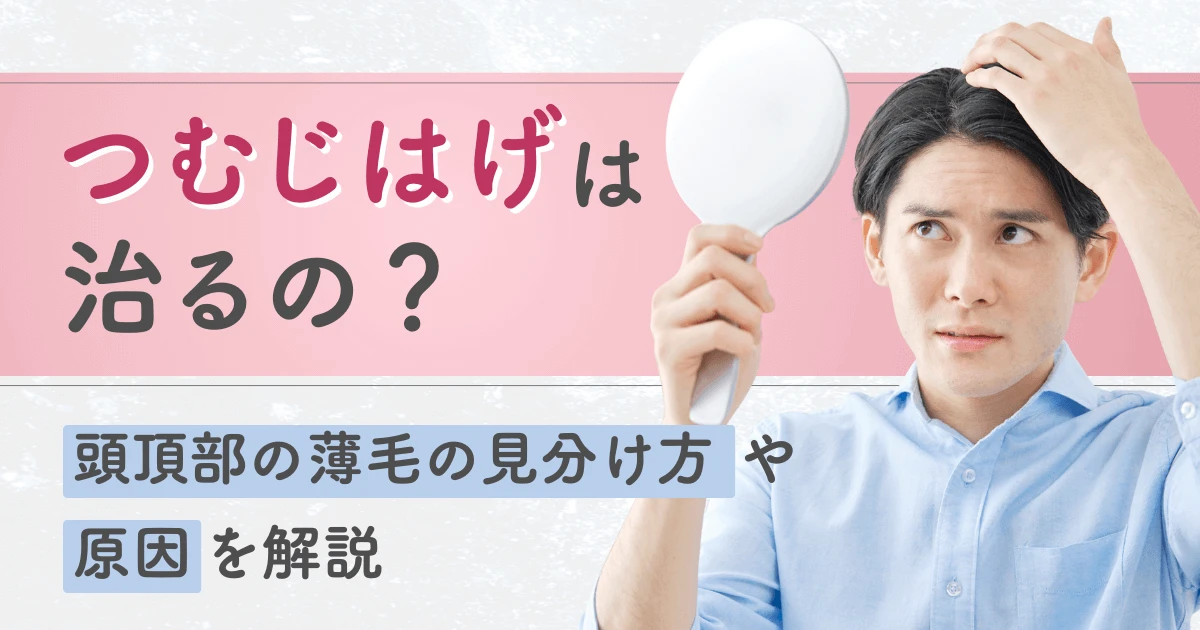 つむじはげは治るの？頭頂部の薄毛の見分け方や原因を解説
